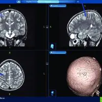 Series of brain MRI scans showing different cross-sectional views, including coronal, sagittal, and axial slices, along with a 3D reconstruction of the skull.