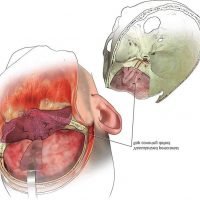 Anatomical illustration showing the dissection of the human head, revealing the internal structures including the brain and nasal cavity.