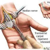 Illustration of a carpal tunnel release surgery showing the median nerve and the transverse carpal ligament being released.