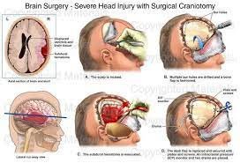 Series of six detailed medical illustrations showing the steps involved in surgical craniotomy for severe head injury, including before and after views.