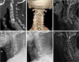 Collage of various spinal imaging scans including CT, X-ray, and MRI views, showing different angles and details of the cervical and lumbar spine.