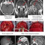 Series of MRI scans and surgical images showing stages of anterior cranial base surgery for olfactory neuroblastoma, from pre-surgery to post-surgery recovery stages.