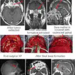 Series of MRI scans and surgical images showing stages of anterior cranial base surgery for olfactory neuroblastoma, from pre-surgery to post-surgery recovery stages.