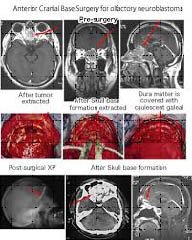 Series of MRI scans and surgical images showing stages of anterior cranial base surgery for olfactory neuroblastoma, from pre-surgery to post-surgery recovery stages.