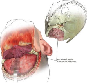 Detailed anatomical illustration showing a dissected view of the human head with sections of the brain, nasal cavity, and muscles highlighted.