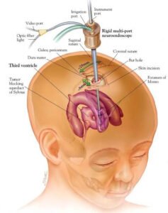 Anatomical illustration showing a neurosurgical procedure using a rigid multi-port neuroendoscope to access the third ventricle of the brain.