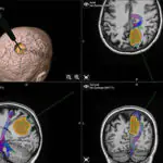 Series of brain scan images with highlighted areas and a 3D model showing a surgical planning tool targeting a brain tumor