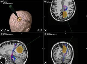 Series of brain scan images with highlighted areas and a 3D model showing a surgical planning tool targeting a brain tumor