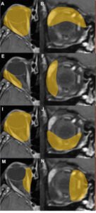 Series of MRI scans of a knee joint highlighted in yellow to show various stages or views, labeled A, B, E, F, I, J, M, and N.