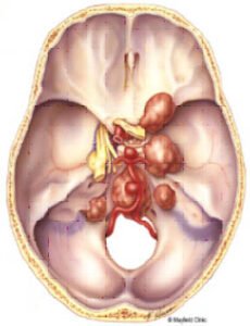 Anatomical illustration of the base of the human skull showing various structures, including arteries and nerves.