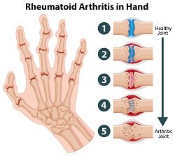 Illustration of a human hand skeleton with five detailed insets showing progression from a healthy joint to an arthritic joint.