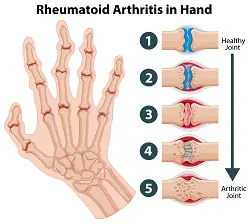 Illustration of a human hand skeleton with five detailed insets showing progression from a healthy joint to an arthritic joint.