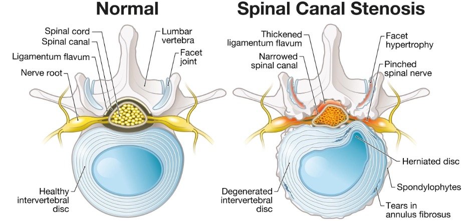 Comparative illustration showing a cross-section of a normal lumbar vertebra and one with spinal canal stenosis, highlighting differences like herniated discs and narrowed spinal canal.