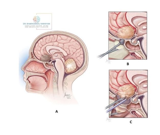 Medical illustration set showing a sagittal view of the human head and brain (A) with detailed views of brain surgery (B and C), depicting surgical tools interacting with brain tissue