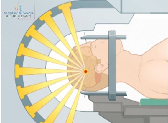 Illustration of a patient undergoing a brain imaging or treatment procedure, with beams focused on a specific area of the brain.