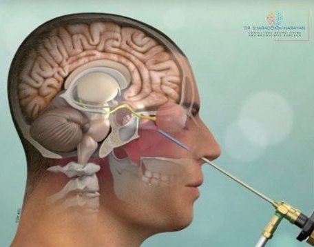 Illustration of a medical procedure involving an endoscope entering through the nose with an anatomical overlay showing the brain, eyes, and sinus pathways
