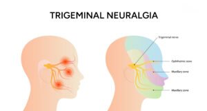 Trigeminal neuralgia treatment in Jamshedpur showing facial nerve pain and trigeminal nerve pathway