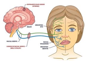Best Doctors for Bell S Palsy Treatment in Jamshedpur explaining what Bell’s palsy is and how facial nerve weakness affects one side of the face