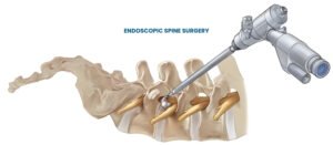 Endoscopic Spine Surgery in Jamshedpur procedure showing minimally invasive spine surgery for slip disc and sciatica treatment