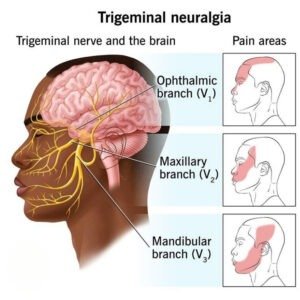 Advanced Trigeminal Neuralgia Treatment in Jamshedpur by Dr. S. Narayan for severe facial nerve pain